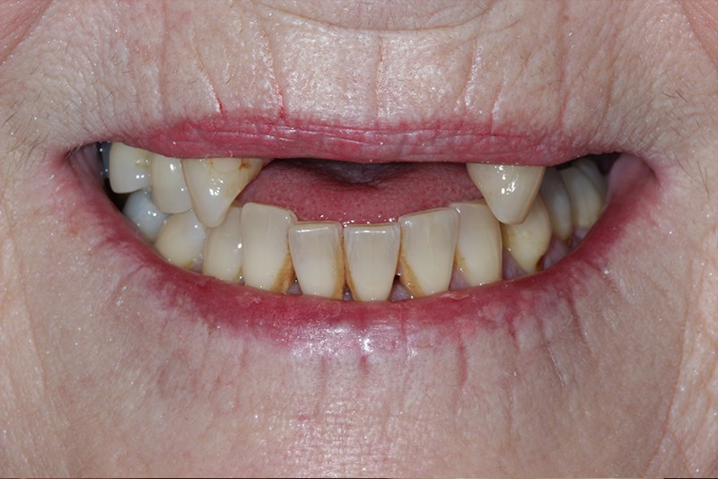 Front Teeth Dentures Allen OK 74825